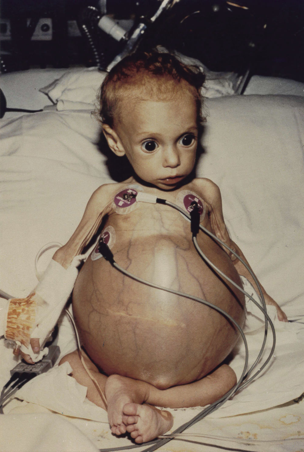 Lily Allen before transplant